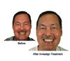 9 - Before And After Invisalign- (Beautiful Straight White Teeth!)